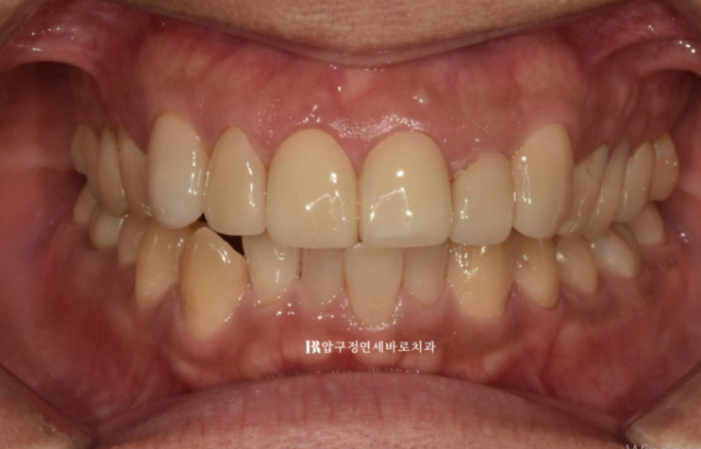 40대 중년 치아교정 인비절라인 라이트 치료기간 8개월 관련 이미지 2