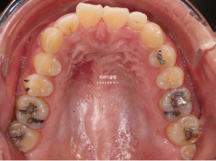 Extraction Orthodontics with Clippy-C for Protruding Mouth, Gum Smile, Gummy Smile Correction, and Treatment for a Recessed Chin image 4