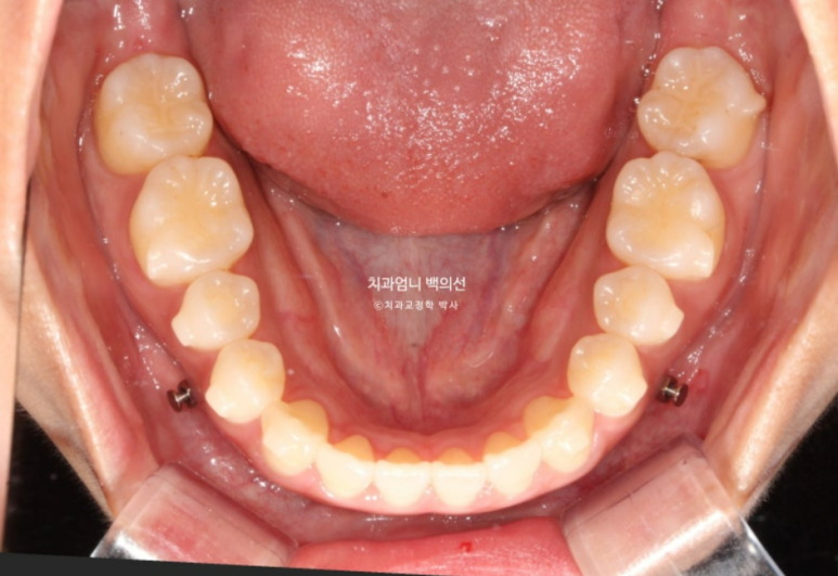 인비절라인 개방교합 교정 어금니 함입 교정 비베라? 관련 이미지 8