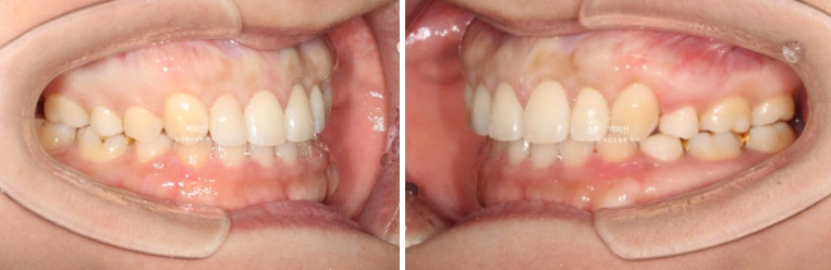 30대 치아교정 돌출입 교정 :: 잇몸미소 거미스마일 교정 입술부전증 결손치 무턱교정 관련 이미지 15