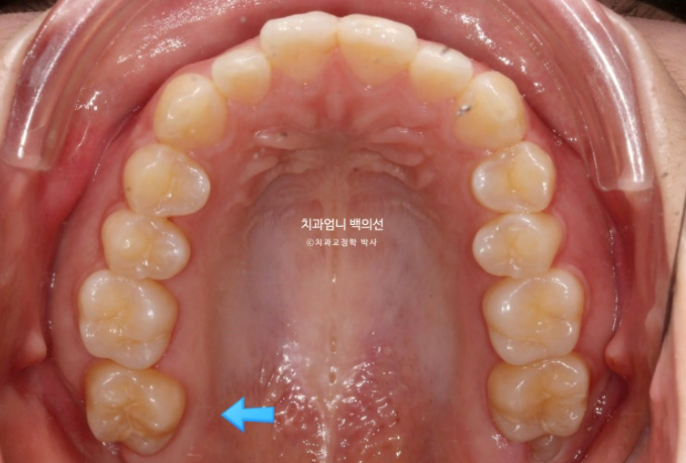 어금니 반대교합&middot;가위교합도 인비절라인 라이트로 교정할 수 있을까? 관련 이미지 6