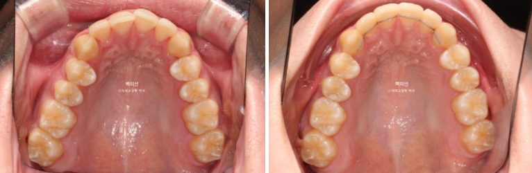 유학생 교정 인비절라인 라이트 치료기간 5개월 관련 이미지 11