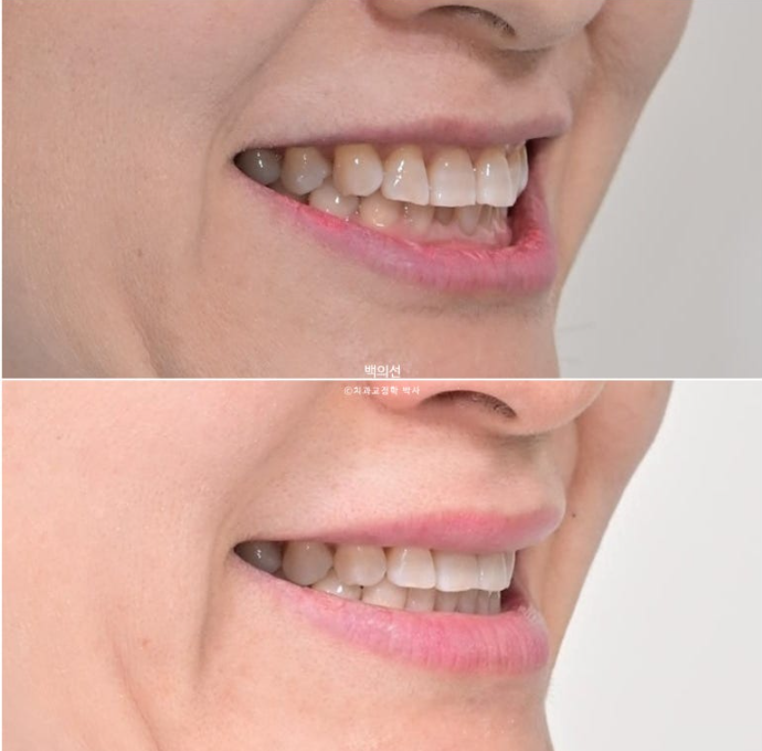50대 치아교정 :: 인비절라인 익스프레스 치아 벌어짐 단기교정 후기 관련 이미지 20