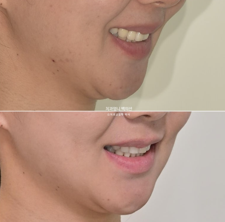 옥니 교정 역교정 재교정 무턱교정 치료기간 1년 10개월 관련 이미지 19