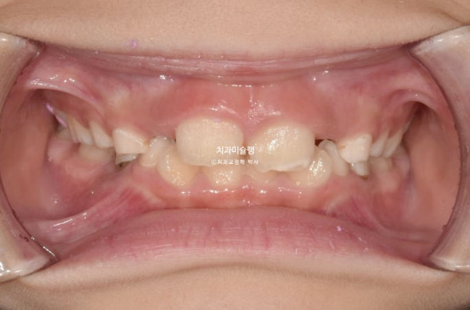어린이 투명교정 인비절라인 퍼스트 과개교합 교정 후기 관련 이미지 2