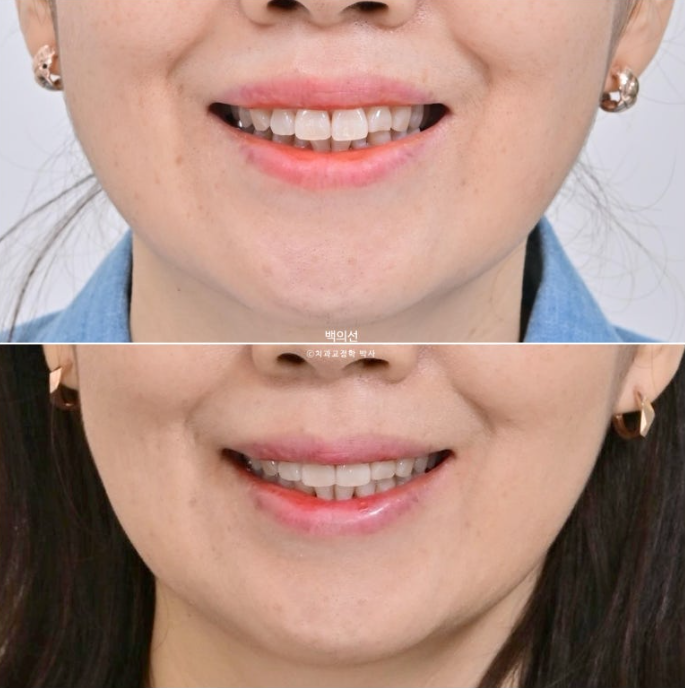 40대 인비절라인 라이트 앞니 돌출 과개교합 덧니 교정 후기 관련 이미지 19