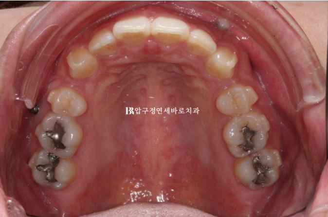Does Invisalign Prevent Root Movement? Before-and-After Comparison of Extraction Treatment for Protruding Lips image 5
