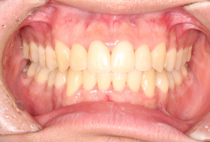 유학생 교정 인비절라인 라이트 치료기간 5개월 관련 이미지 9