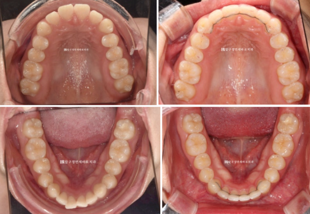돌출입 교정 치아 벌어짐 인비절라인 투명교정 치료 관련 이미지 10