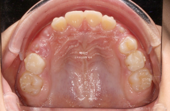 인비절라인퍼스트 어린이 투명교정 과개교합 덧니 악궁확장 돌출 관련 이미지 9