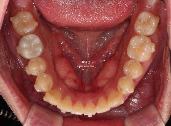 가위교합 나비치아 미니스크류 덧니 교정 인비절라인 라이트 관련 이미지 15