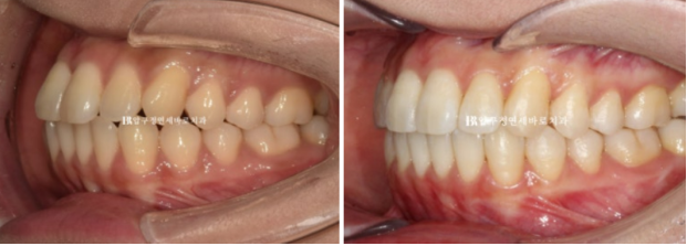 9-Month Invisalign Lite Review|Real Case Improving a Crossbite and Crooked Teeth Together image 9
