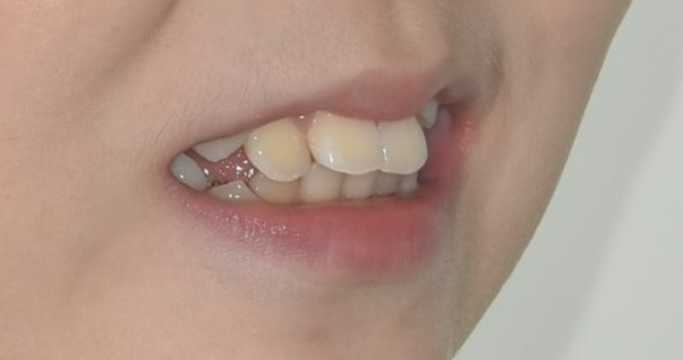 인비절라인 퍼스트, 결국 다시 교정해야 할까? 관련 이미지 4