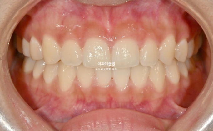 유학생 치아교정 해외거주 한국에서 치아교정? 관련 이미지 13