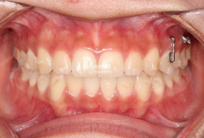 유학생 치아교정 해외거주 한국에서 치아교정? 관련 이미지 9