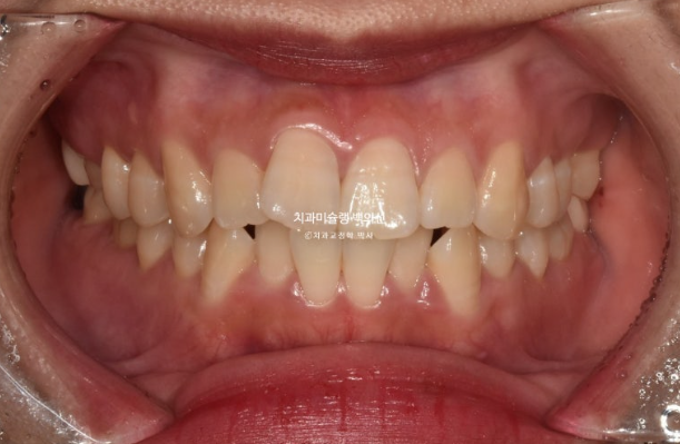 인비절라인 돌출입 발치교정 임플란트 없이 사랑니 대체 관련 이미지 2