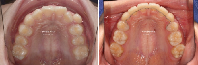 덧니 돌출입 발치교정 상악만 2개 편악 발치 클리피씨 입술부전증 치료 관련 이미지 12