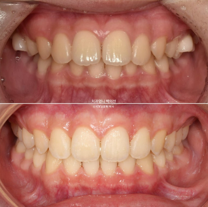 어린이 투명교정 인비절라인 퍼스트 가위교합 돌출교정 덧니교정 관련 이미지 12