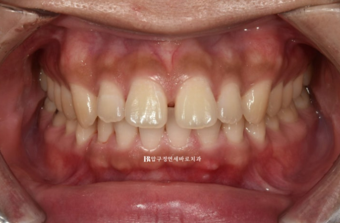 Can Invisalign Fix a Gap Between the Front Teeth? ๐ฎ A Real 9-Month Case Finished Without Remaking Aligners image 1