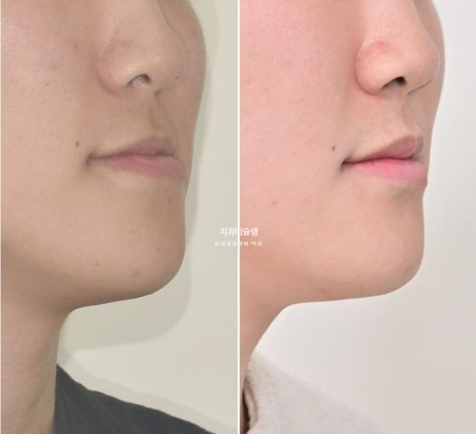 비수술 비발치 주걱턱 절충치료 클리피씨 개방교합 반대교합 치료 관련 이미지 18