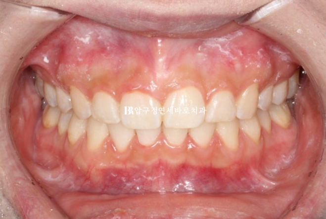 Does Invisalign Prevent Root Movement? Before-and-After Comparison of Extraction Treatment for Protruding Lips image 9