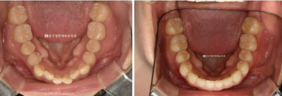 급속 교정 앞니부분교정 치료 무삭제 라미네이트 후기 관련 이미지 11