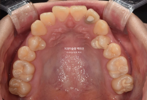 잇몸미소 인비절라인 거미스마일 토끼이빨 교정 무삭제 라미네이트 반대교합 치료 후기 관련 이미지 4
