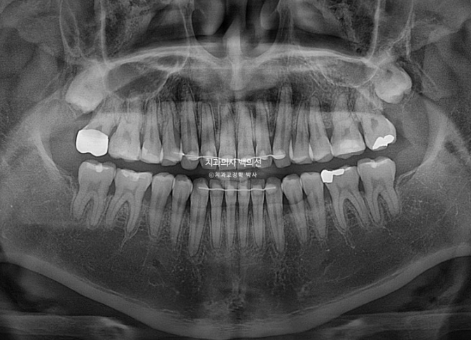 30대 주걱턱 비수술 비발치 교정 후기 관련 이미지 16
