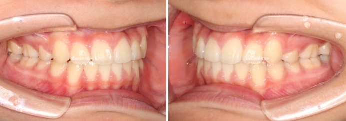 덧니 돌출입 발치교정 상악만 2개 편악 발치 클리피씨 입술부전증 치료 관련 이미지 11