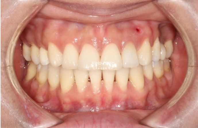 옥니 역교정 재교정 무턱 교정 치료기간 1년 10개월 관련 이미지 12