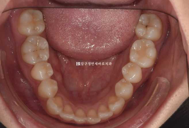 Can Rabbit Teeth Be Corrected? 5-Month Real Case of Butterfly Teeth Anterior Partial Orthodontic Treatment image 5