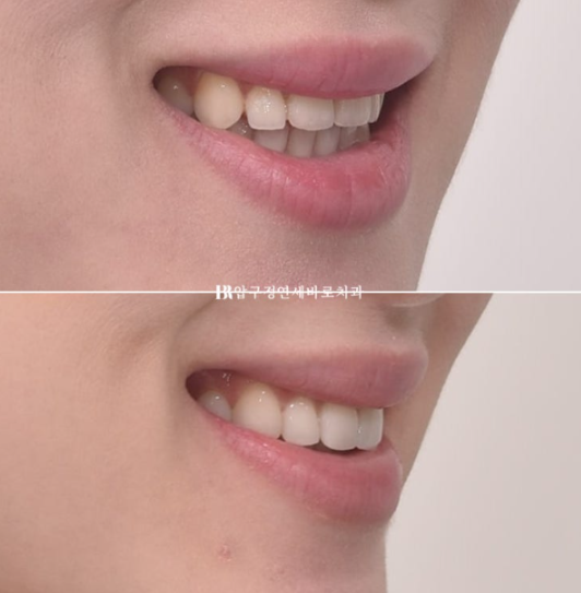 Non-Prep Veneer Review | A Case Naturally Improving Gaps Between the Front Teeth and the Smile Line image 14