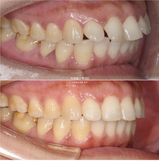 40대 인비절라인 라이트 앞니 벌어짐 뻗침 돌출 치료 관련 이미지 16