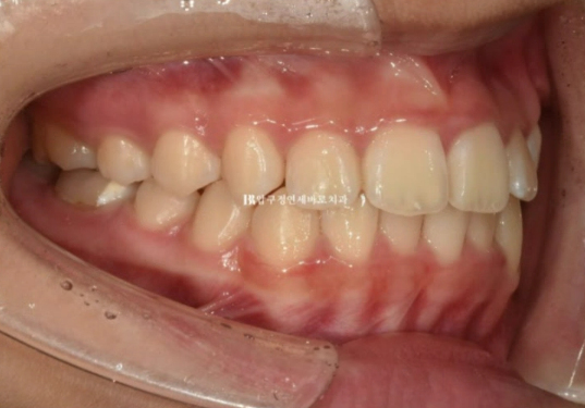 어린이 투명교정 인비절라인 틴 덧니 교정 후기 관련 이미지 5