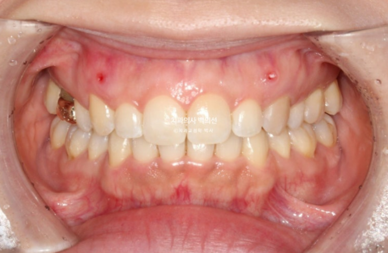 인비절라인 라이트 재교정 발치공간 벌어짐 ? 관련 이미지 7