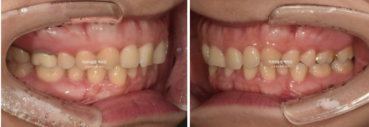비발치 덧니 교정 인비절라인 과개교합 교정 무삭제 라미네이트 치료 후기 관련 이미지 3