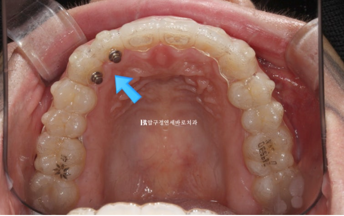 인비절라인 라이트 과개교합 반대교합 돌출입 뻐드렁니 교정 치료 관련 이미지 11