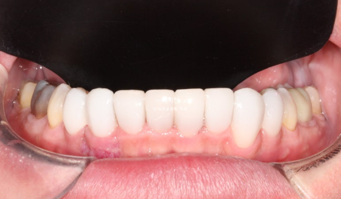 Treatment Review: No-Prep Laminate for Tetracycline-Stained Teeth image 14