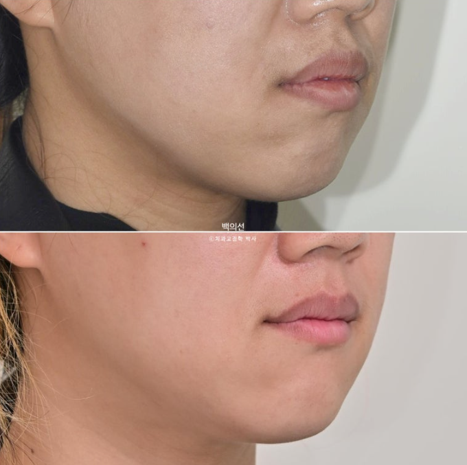 거미스마일 교정 돌출입 발치교정 입술부전 호두턱 치료기간 2년반 관련 이미지 23