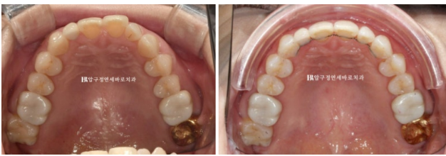 Can Invisalign Lite Work for Patients in Their 40s? A Real Case Improving Scissor Bite and Deep Bite in 10 Months image 16