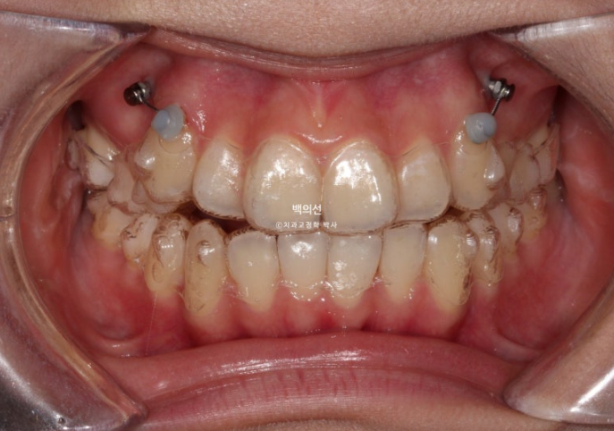 비발치 덧니교정 인비절라인 교정 사랑니 이용 교정 관련 이미지 8