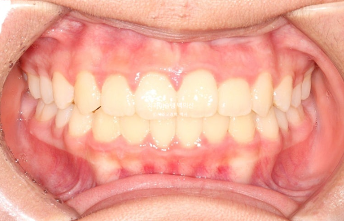 덧니 반대교합 과개교합 인비절라인 퍼스트 악궁확장 어린이 교정 치료 관련 이미지 18