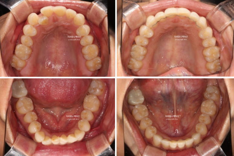 인비절라인 비발치 덧니 교정 반대교합 치료 후기 관련 이미지 15