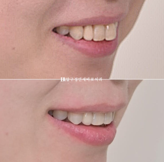 40대 인비절라인 라이트 가위교합? 관련 이미지 19