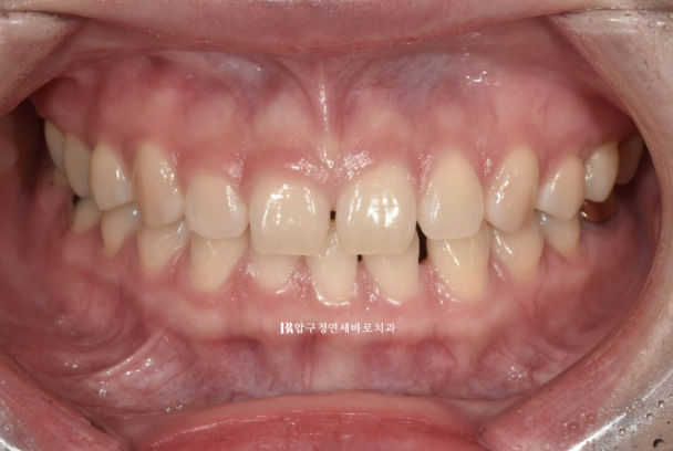 Four No-Prep Veneers for Dwarf Teeth and Conical Front Teeth image 1
