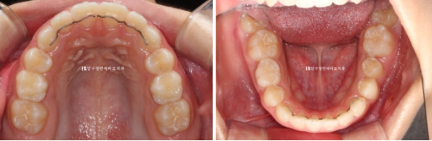 강남 소아교정 인비절라인 퍼스트 어린이 반대교합 관련 이미지 13