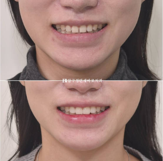 왜소치·원추형 치아, 교정보다 무삭제 라미네이트가 좋은 이유 | 앞니 벌어짐 치료 후기 관련 이미지 9