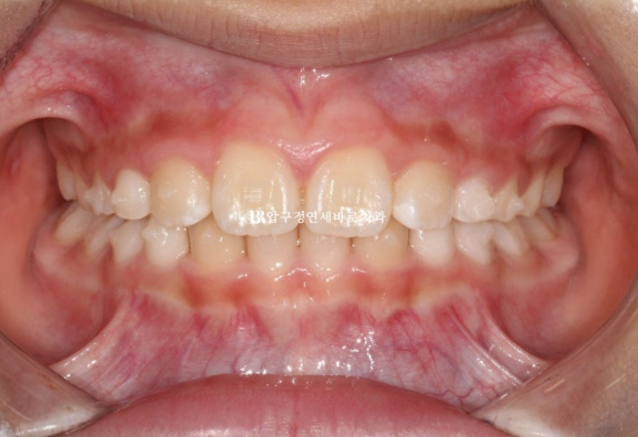 Invisalign First Correction for a Retruded Chin in a Child Orthodontic Treatment for Protrusion image 5