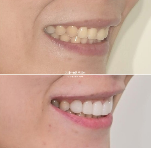 비발치 덧니 교정 인비절라인 과개교합 교정 무삭제 라미네이트 치료 후기 관련 이미지 24