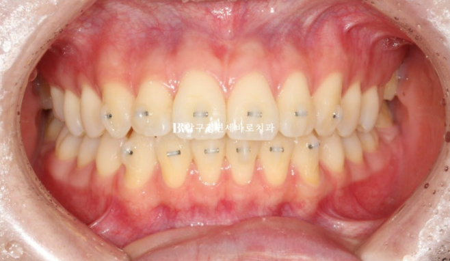 Orthodontic Treatment for International Students: Is Short-Term Treatment Possible in Korea? | A Real 5-Month Front Teeth Partial Orthodontic Case image 4